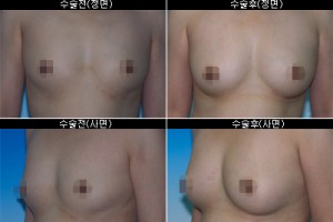 [리포킷플러스] 지방이동술 자가지방이동 유방확대술 수술 전후